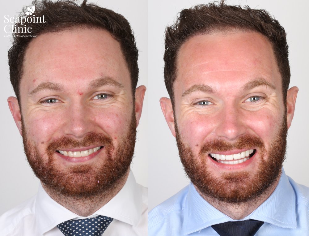 instant veneers