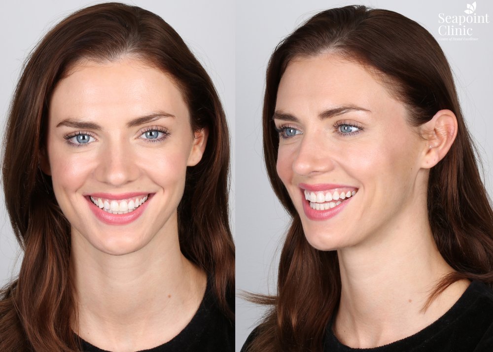 6 month braces rebecca fleetwood