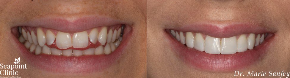 instant veneers