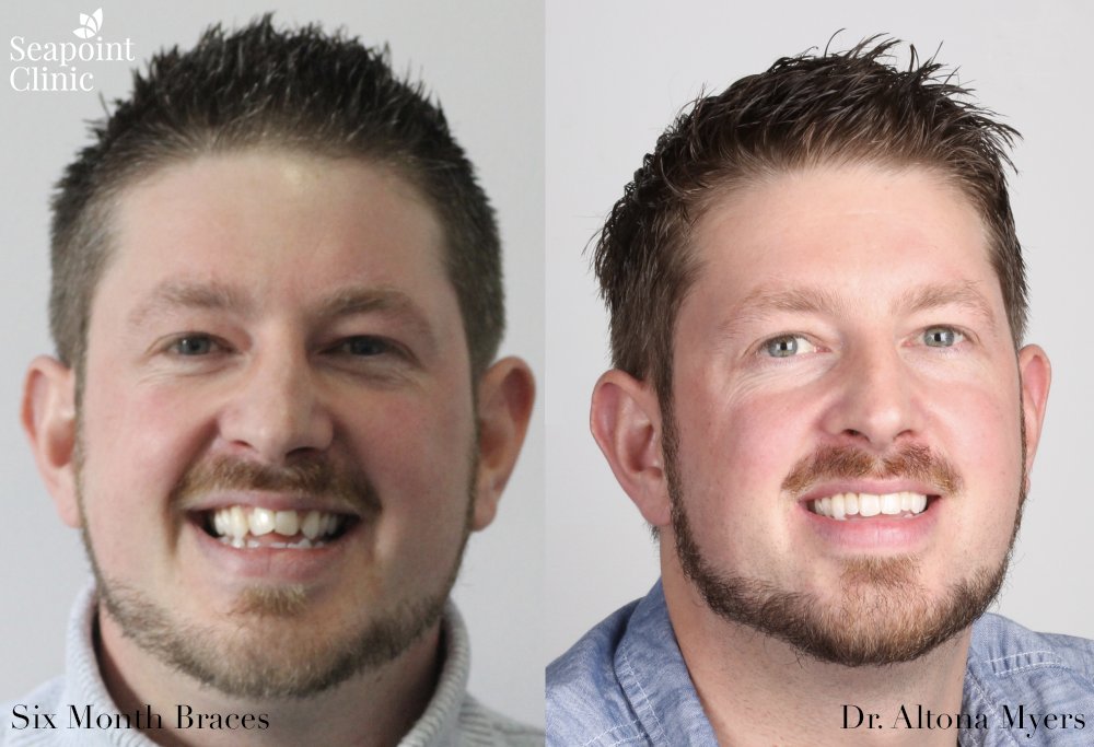 keith smith six month braces