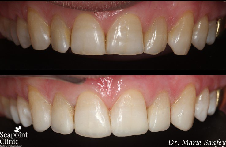 instant veneers