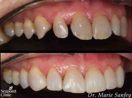 instant veneers
