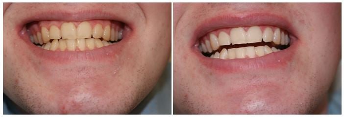teeth whitening cost