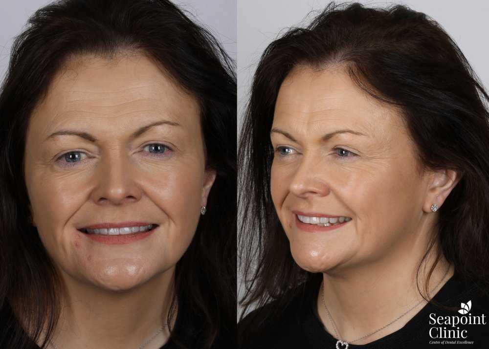 instant veneers teeth whitening