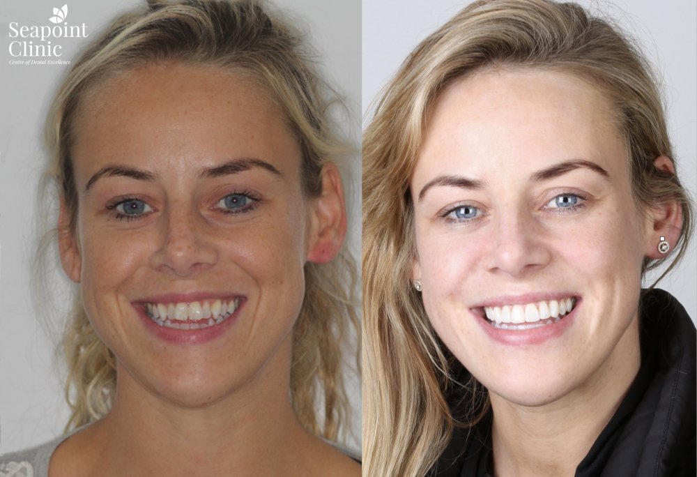 instant veneers
