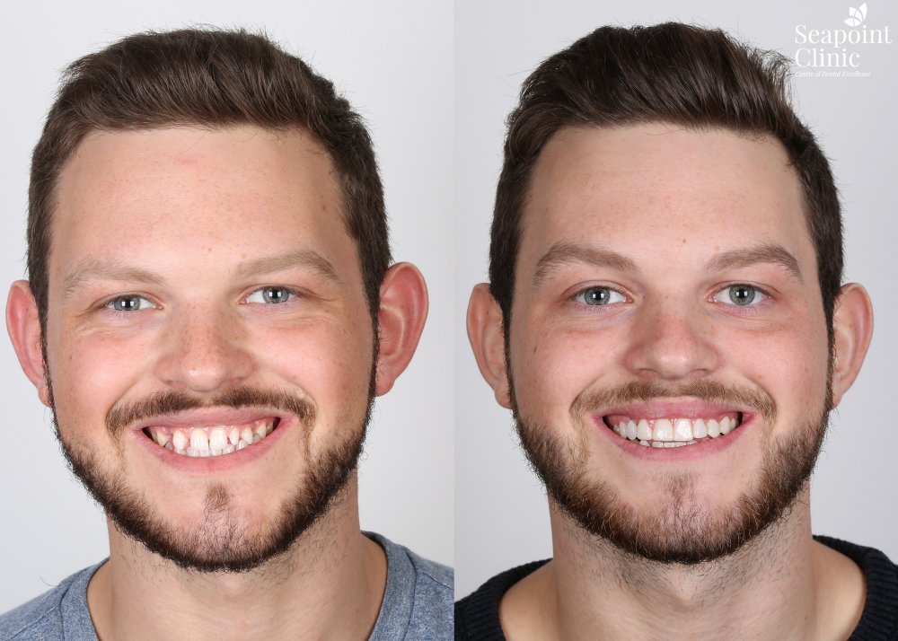 composite veneers white teeth smiling