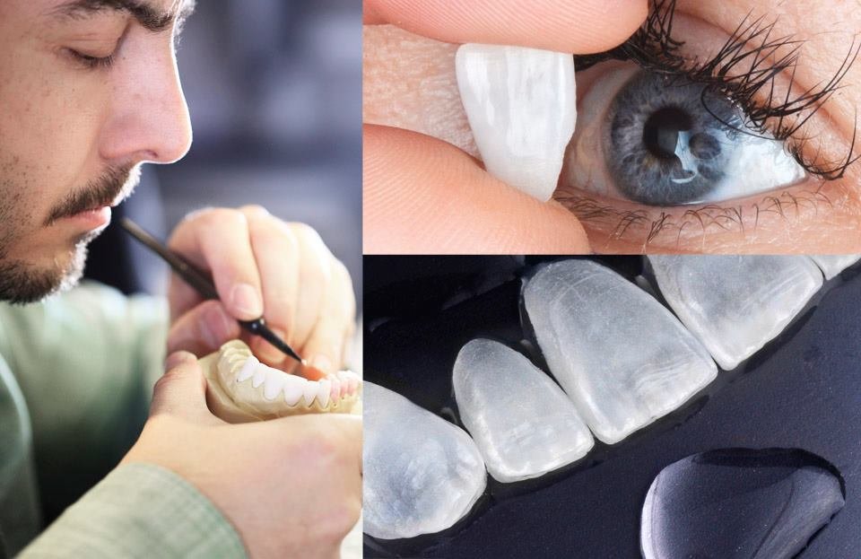 davinci veneers