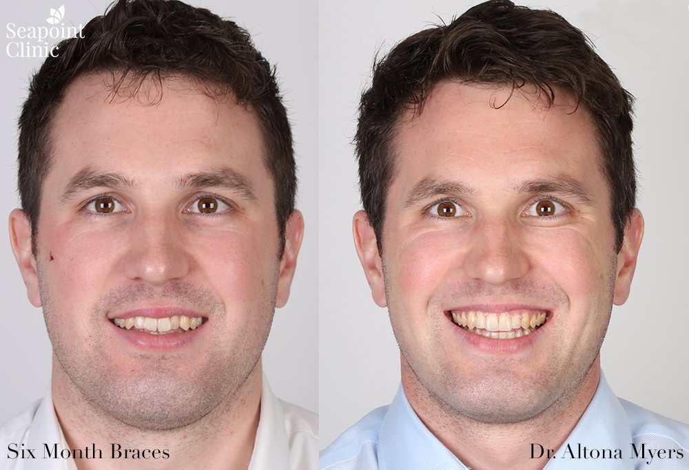 six month braces groom wedding