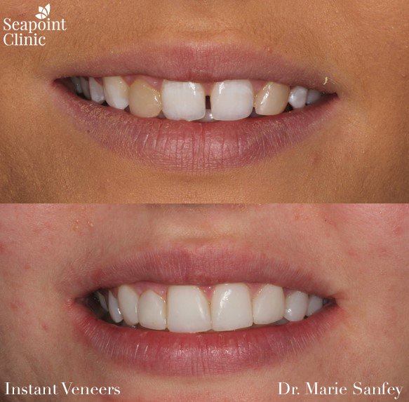 instant veneers smile