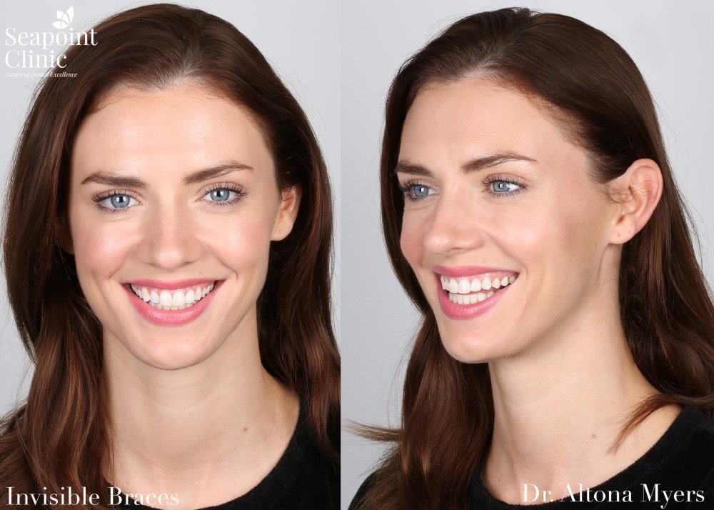 6 month braces rebecca fleetwood