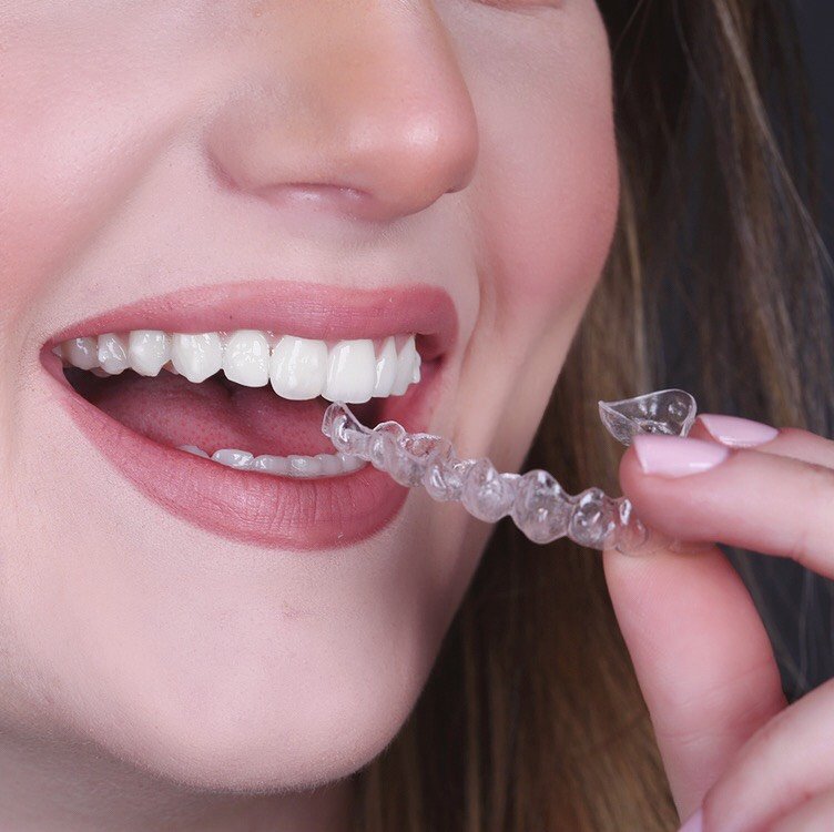 invisalign aligners up close