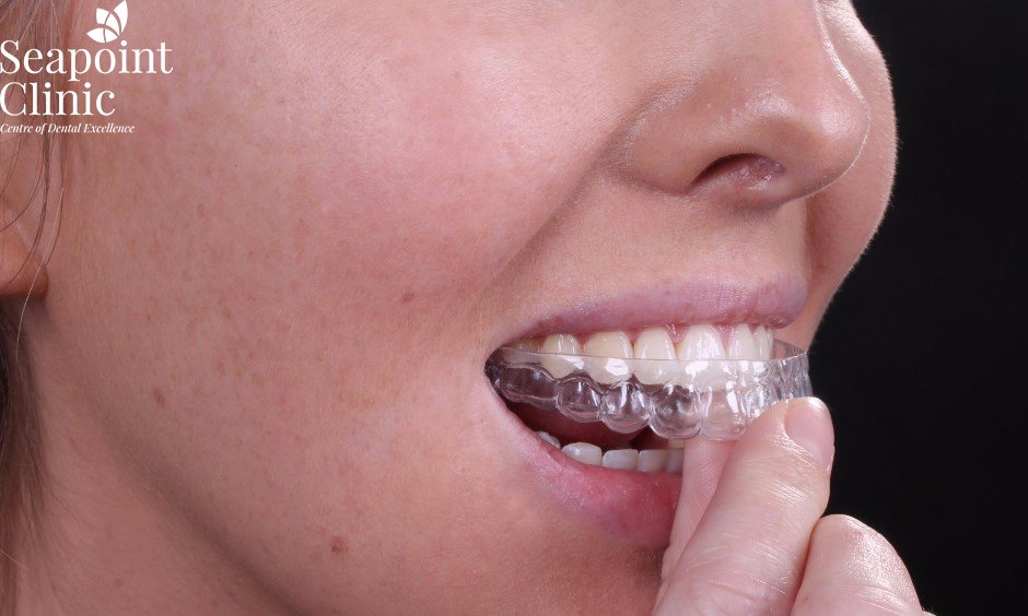 dental aligner