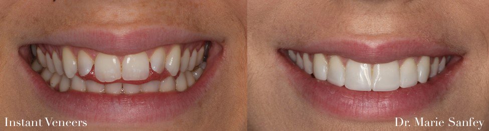 instant veneers