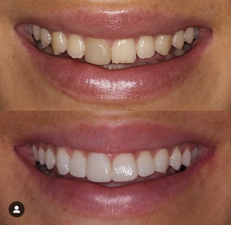 instant veneers smile white teeth