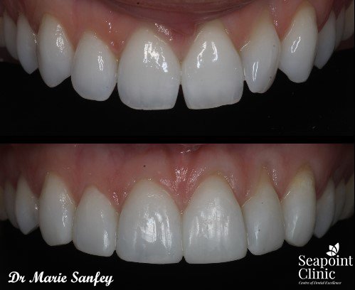 close ups instant composite veneers