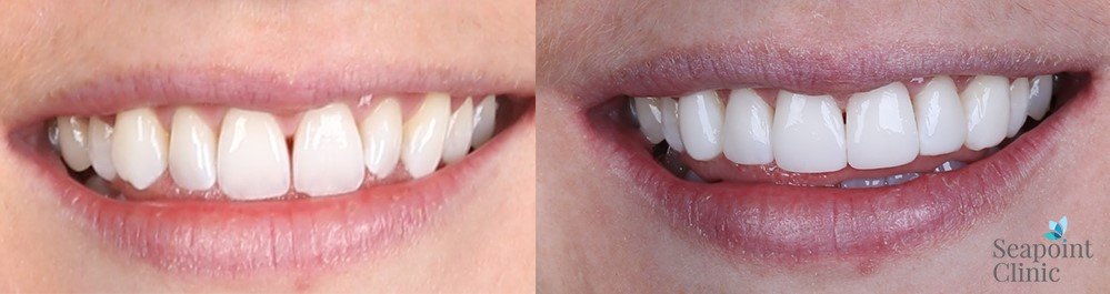 Rachel Mac Carthy composite veneers