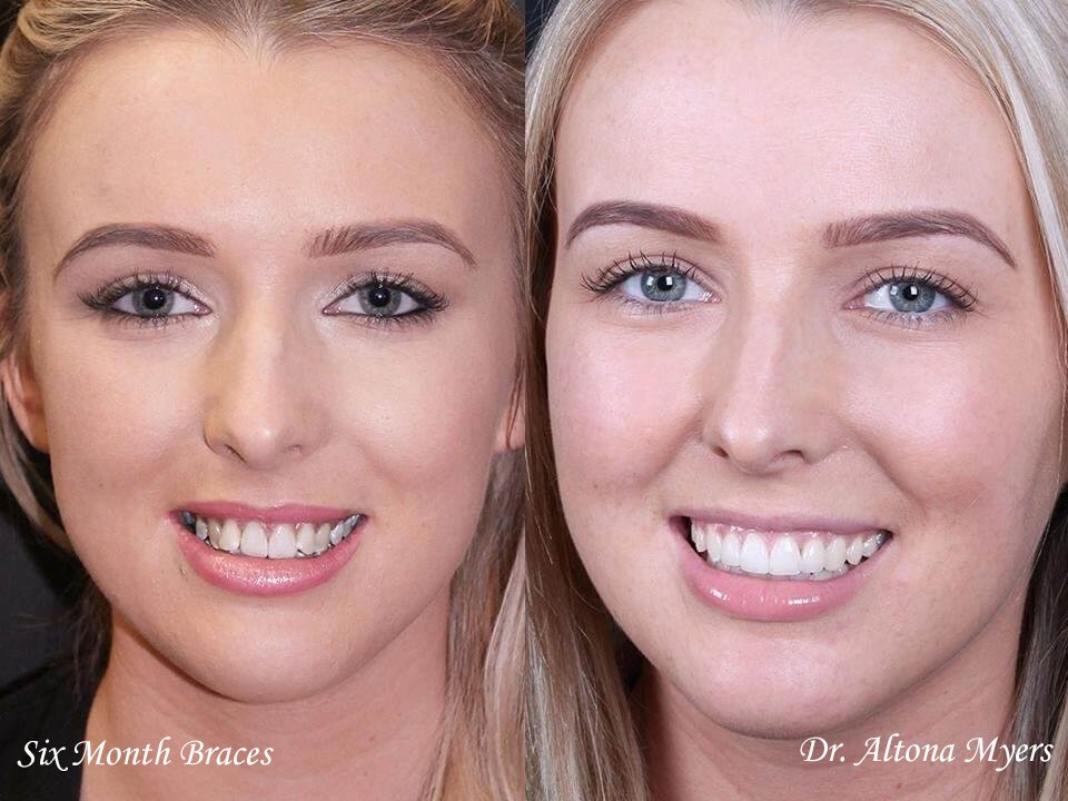 six month braces