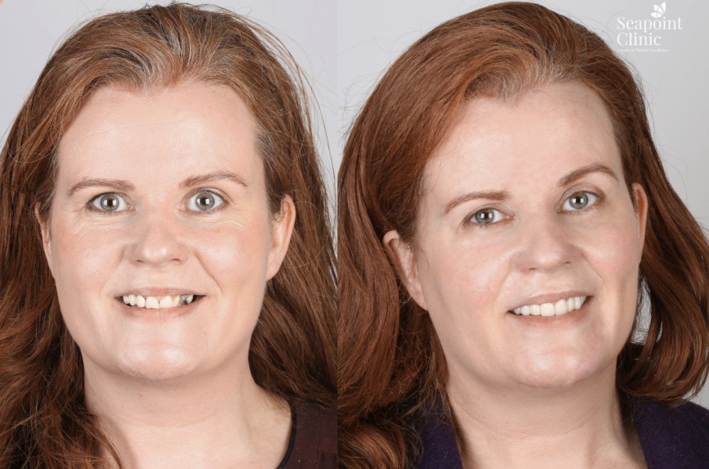 dental implants