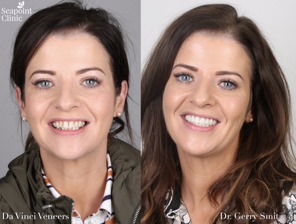 dental veneers