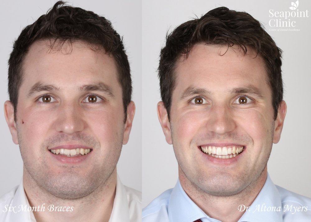 six month braces groom wedding