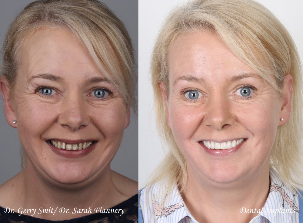 caroline duffy dental implants veneers