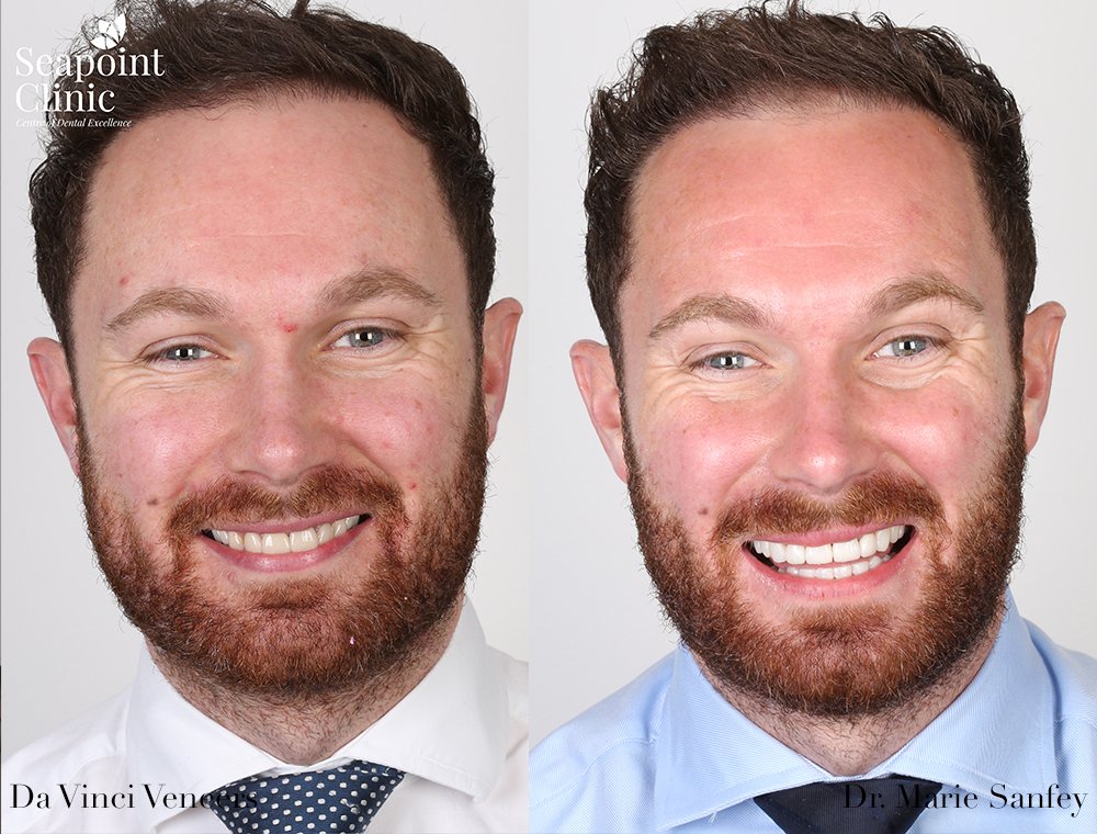 instant veneers