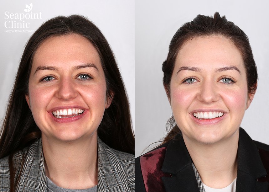 Clare Corkery Instant Composite Veneers