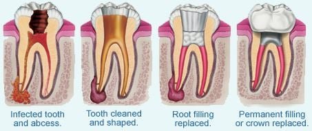 root canal treatment