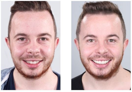 veneers