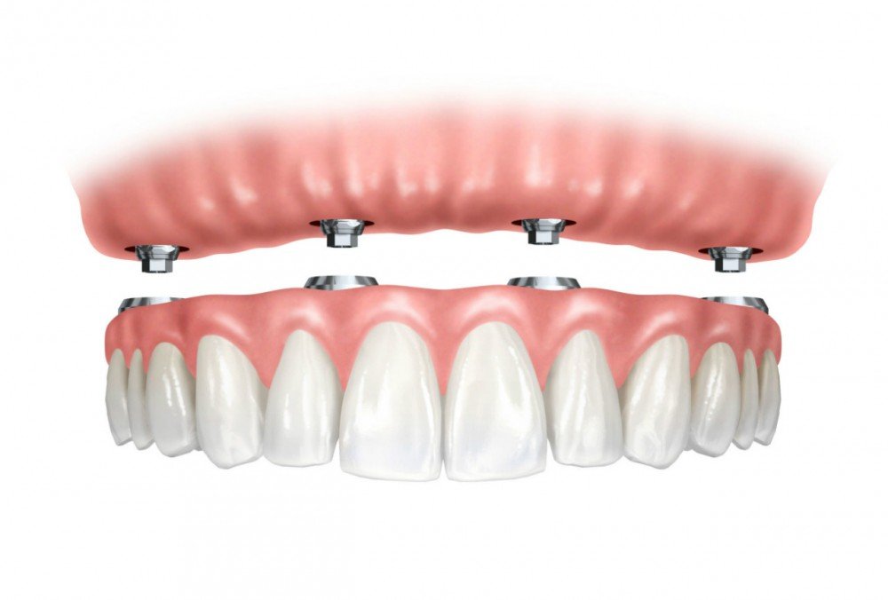 teeth in a day