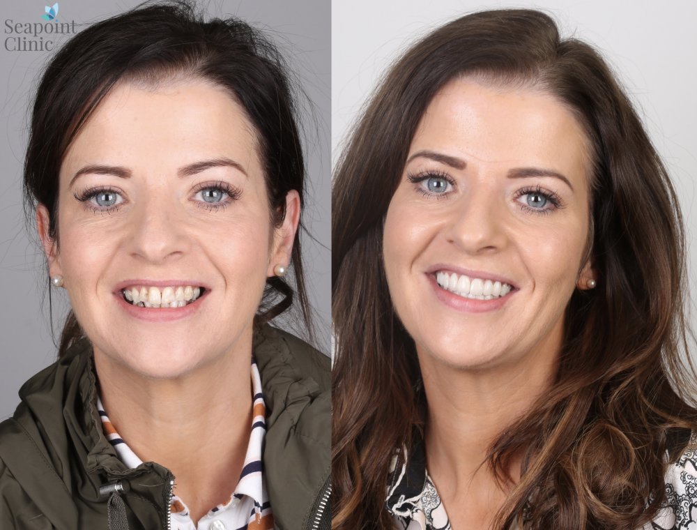 veneers