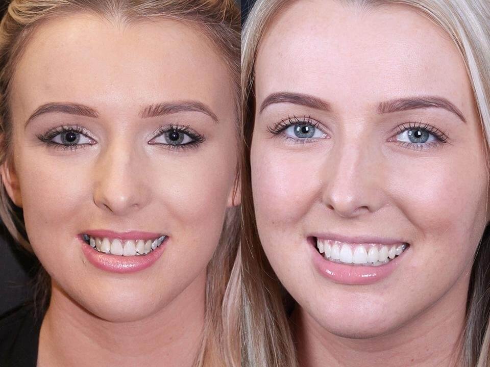 six month braces