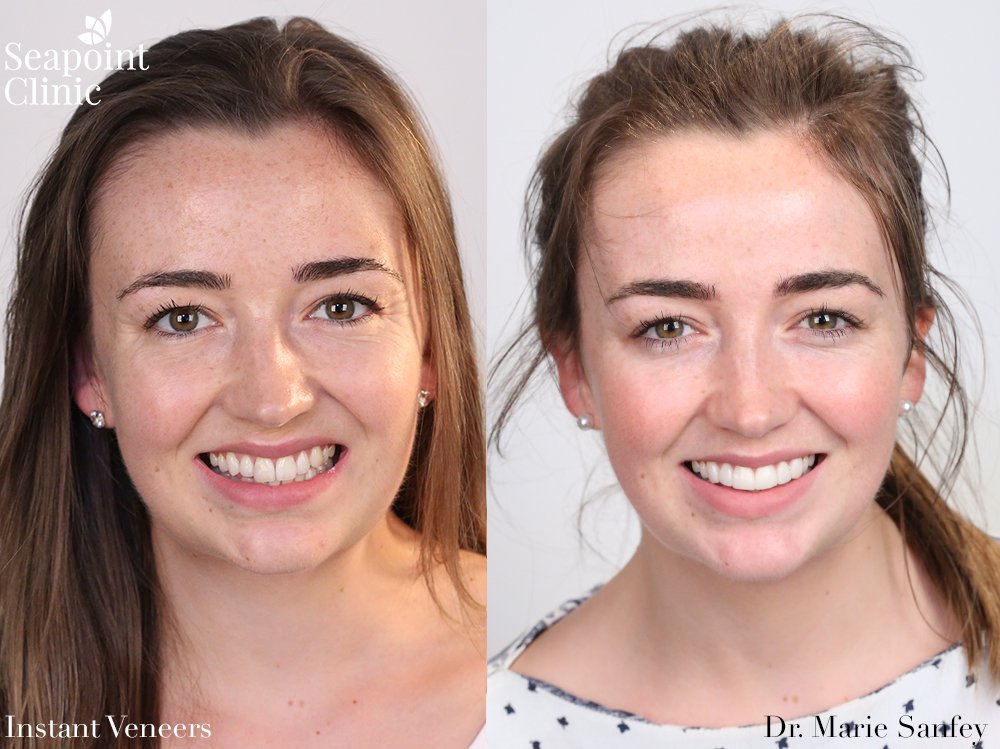 composite veneers white teeth