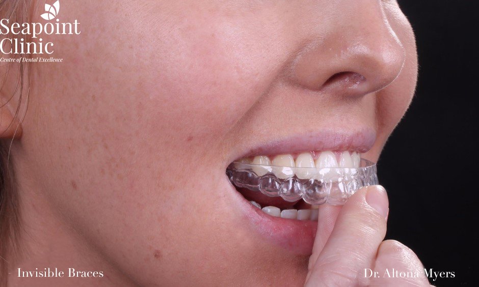 dental aligner invisible brace