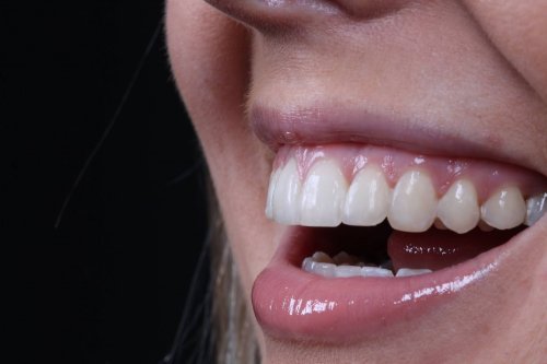 Can You Get Braces With Teeth Missing Seapoint Clinic Dental Clinic