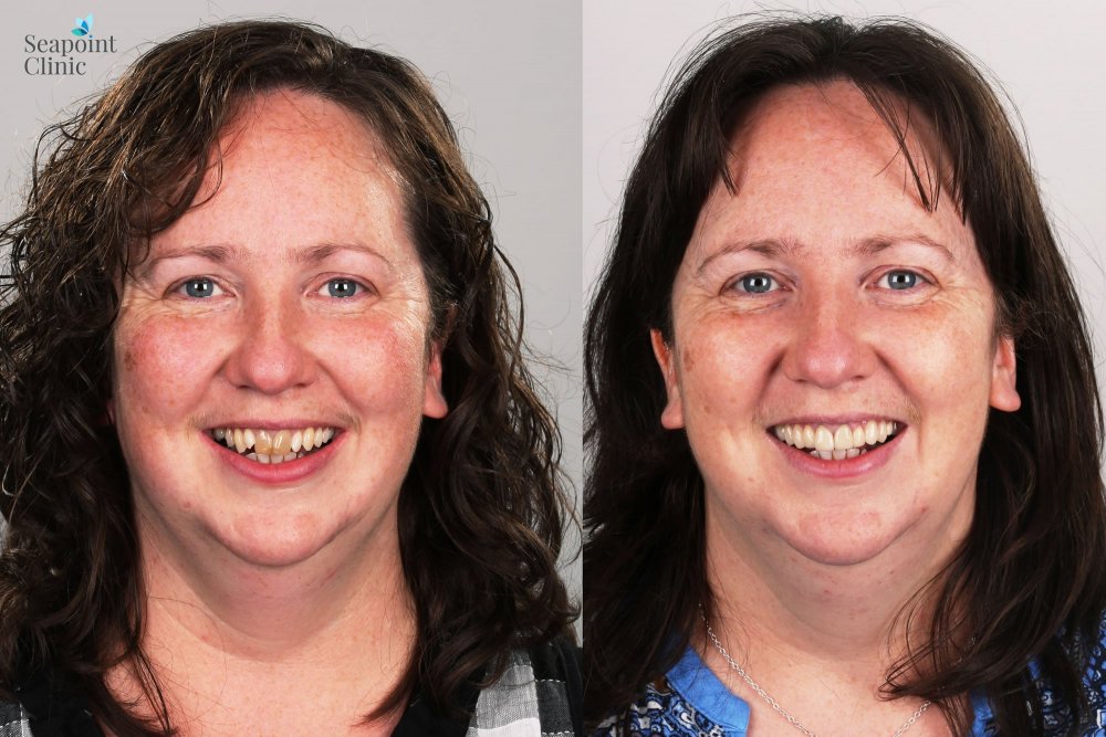 Digital Smile Design Cosmetic Dentistry Smile Design