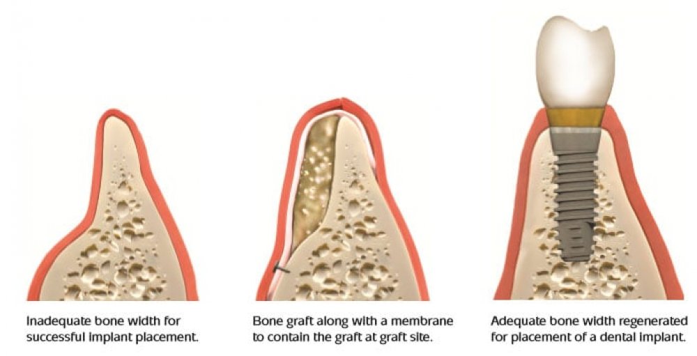 bone graft dental implant, implant dentistry